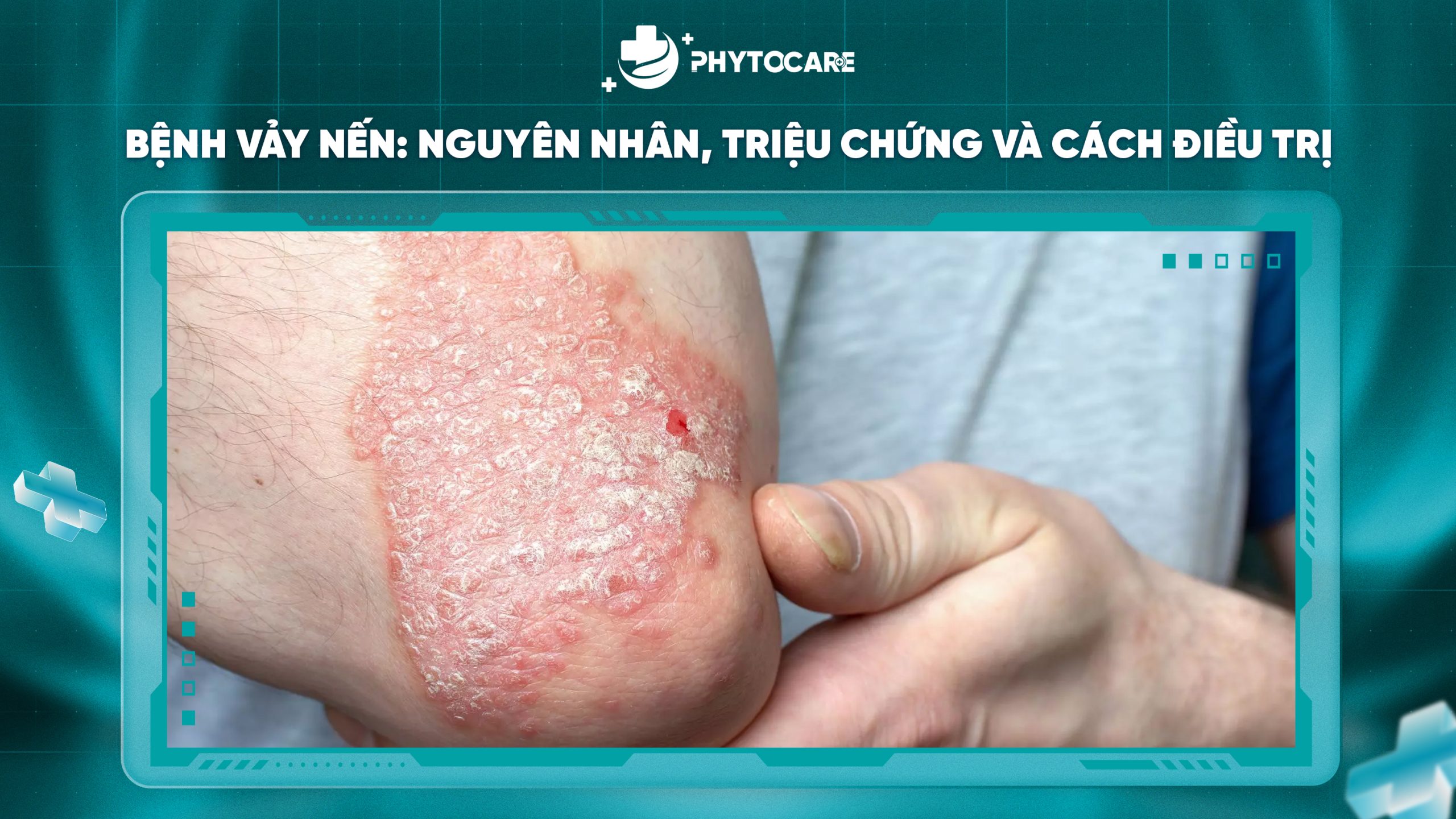 Viêm da cơ địa: Nguyên nhân, triệu chứng và cách điều trị hiệu quả