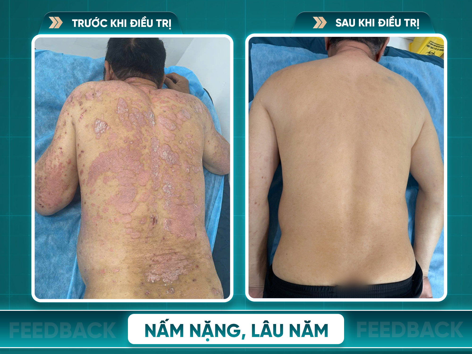 Kết quả trước và sau điều trị vảy nến