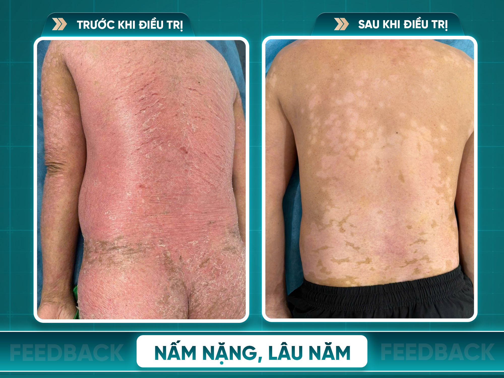 Kết quả trước và sau điều trị vảy nến
