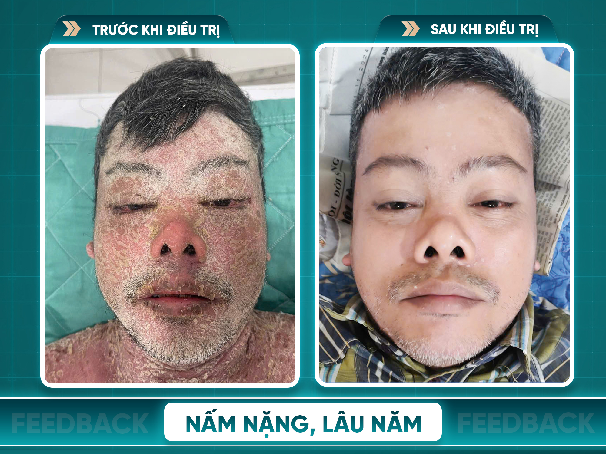 Kết quả trước và sau điều trị vảy nến