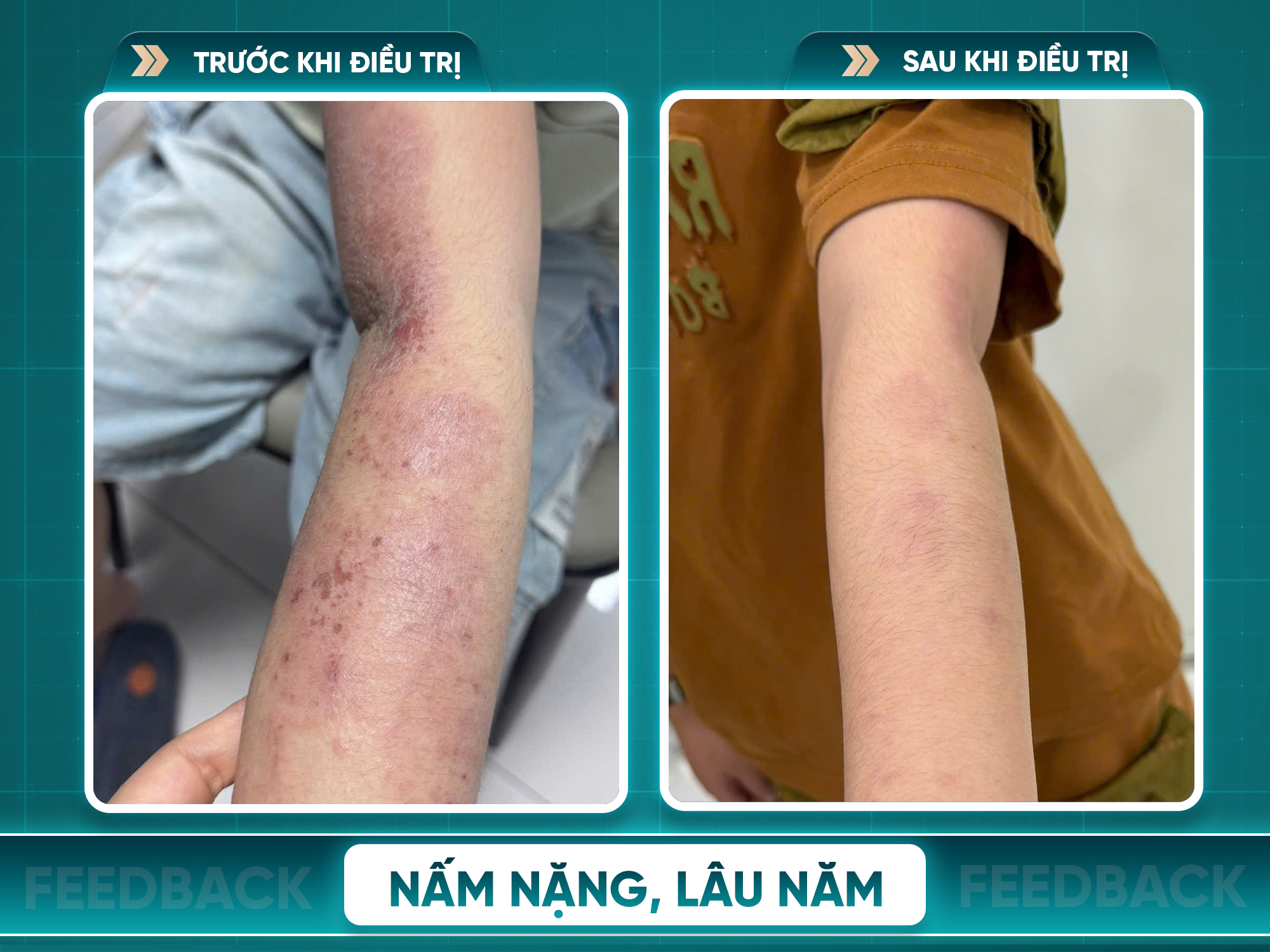 Kết quả trước và sau điều trị viêm da cơ địa