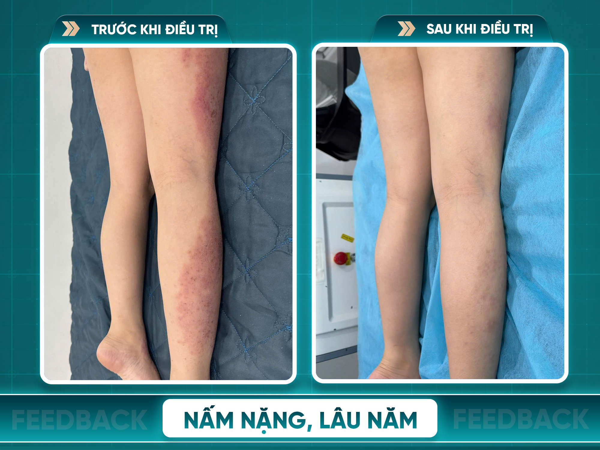 Kết quả trước và sau điều trị viêm da cơ địa