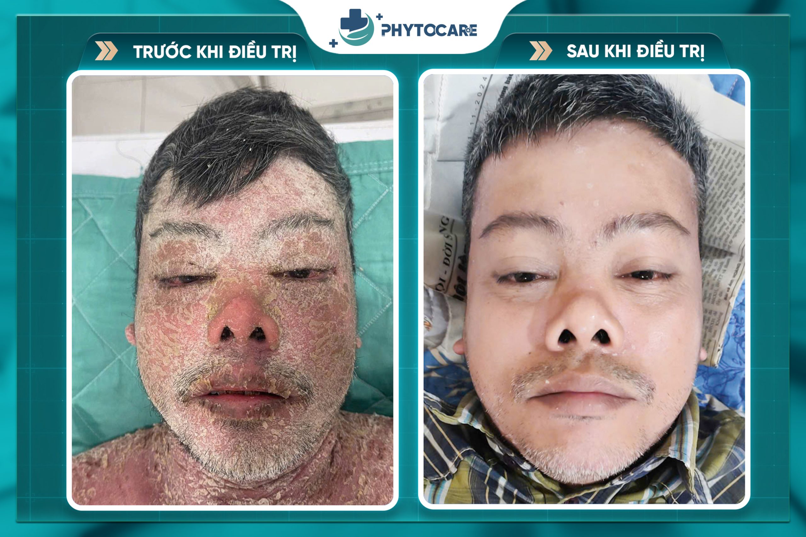 Hiệu quả trước sau điều trị 1