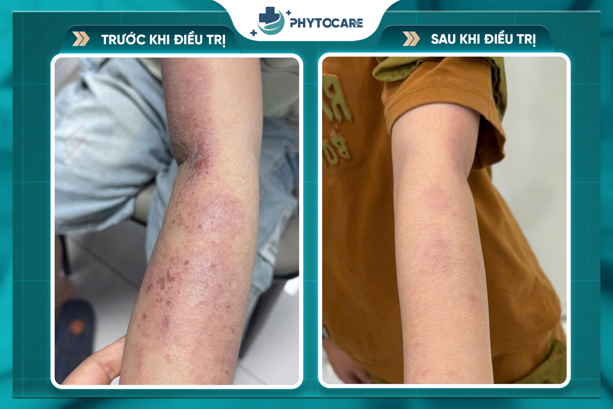 Hiệu quả trước sau điều trị 2
