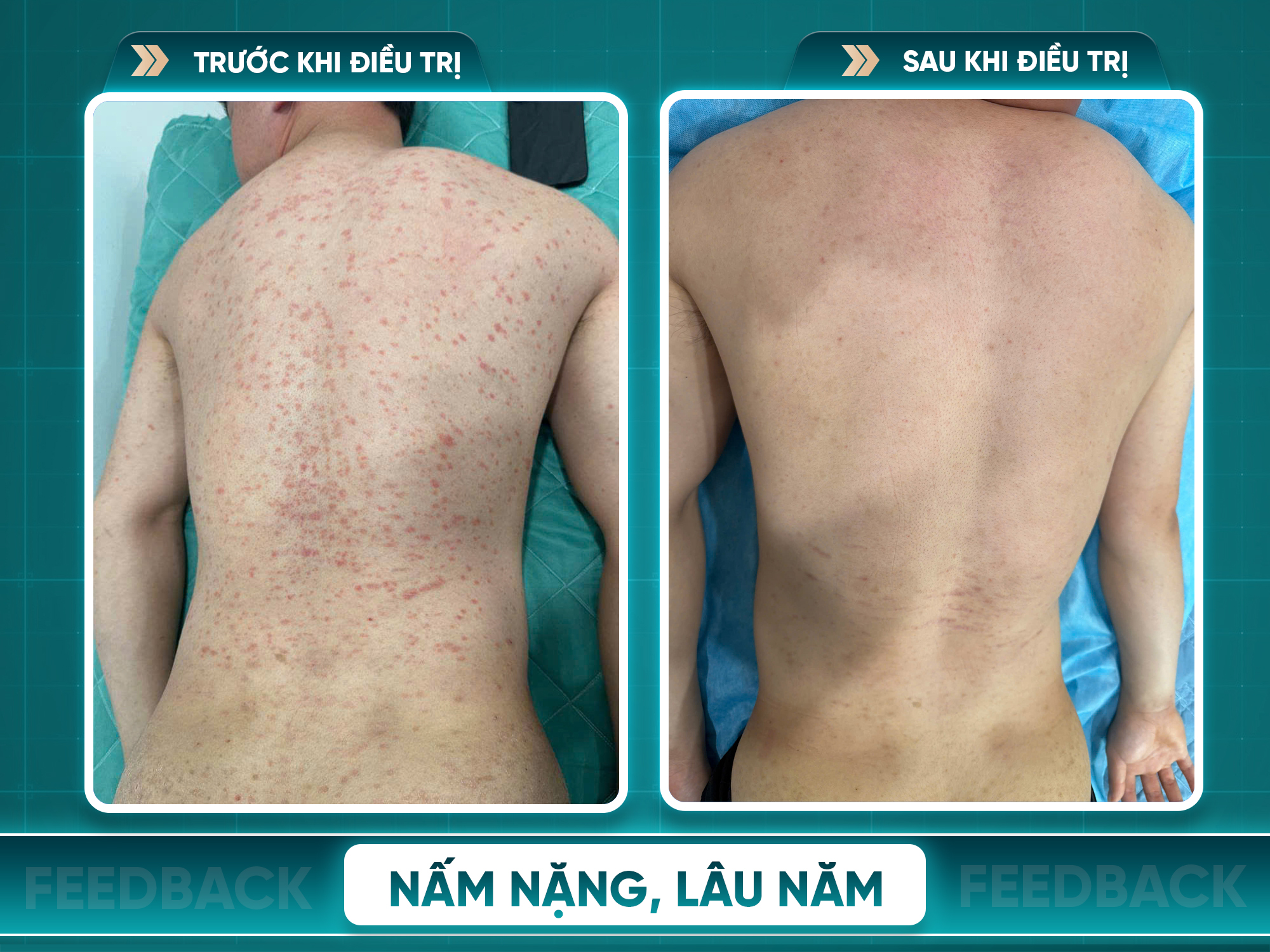Kết quả trước và sau điều trị viêm da cơ địa