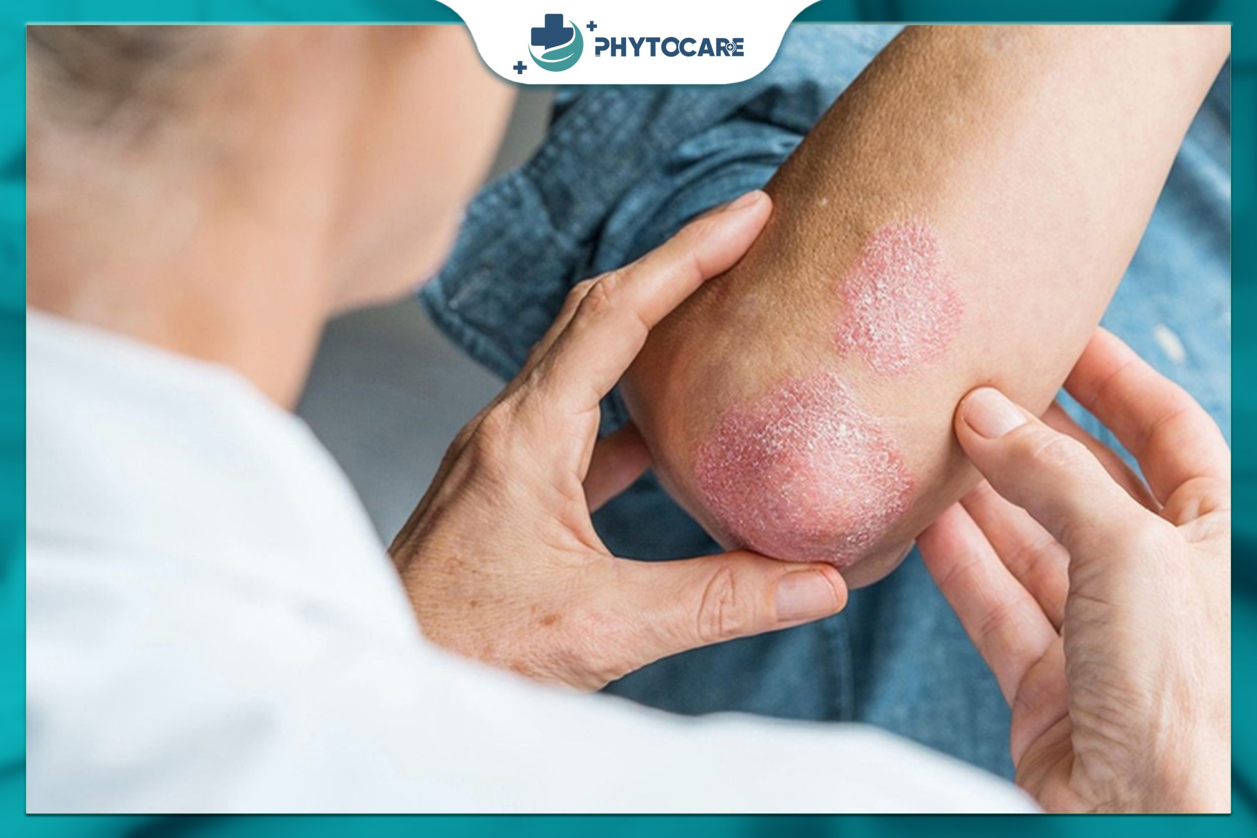 Chẩn đoán bệnh nấm da