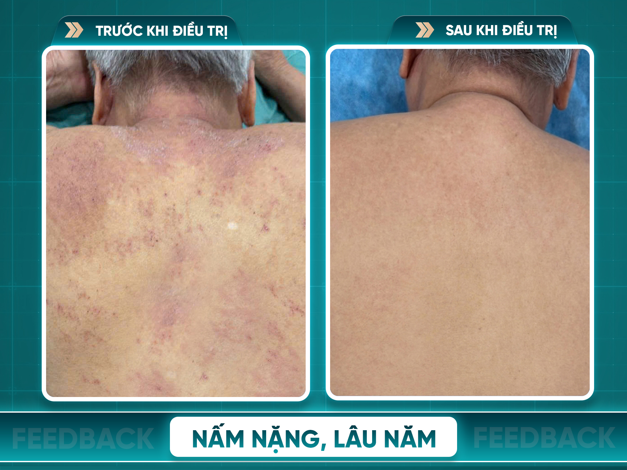 Kết quả trước và sau điều trị nấm da