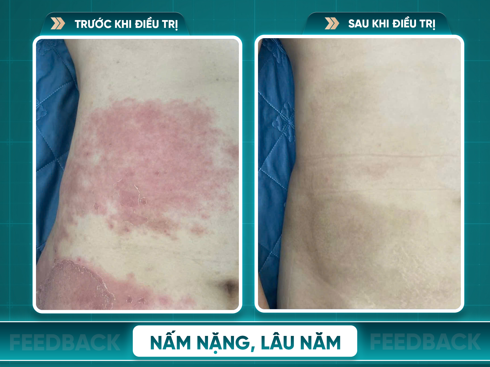 Kết quả trước và sau điều trị nấm da