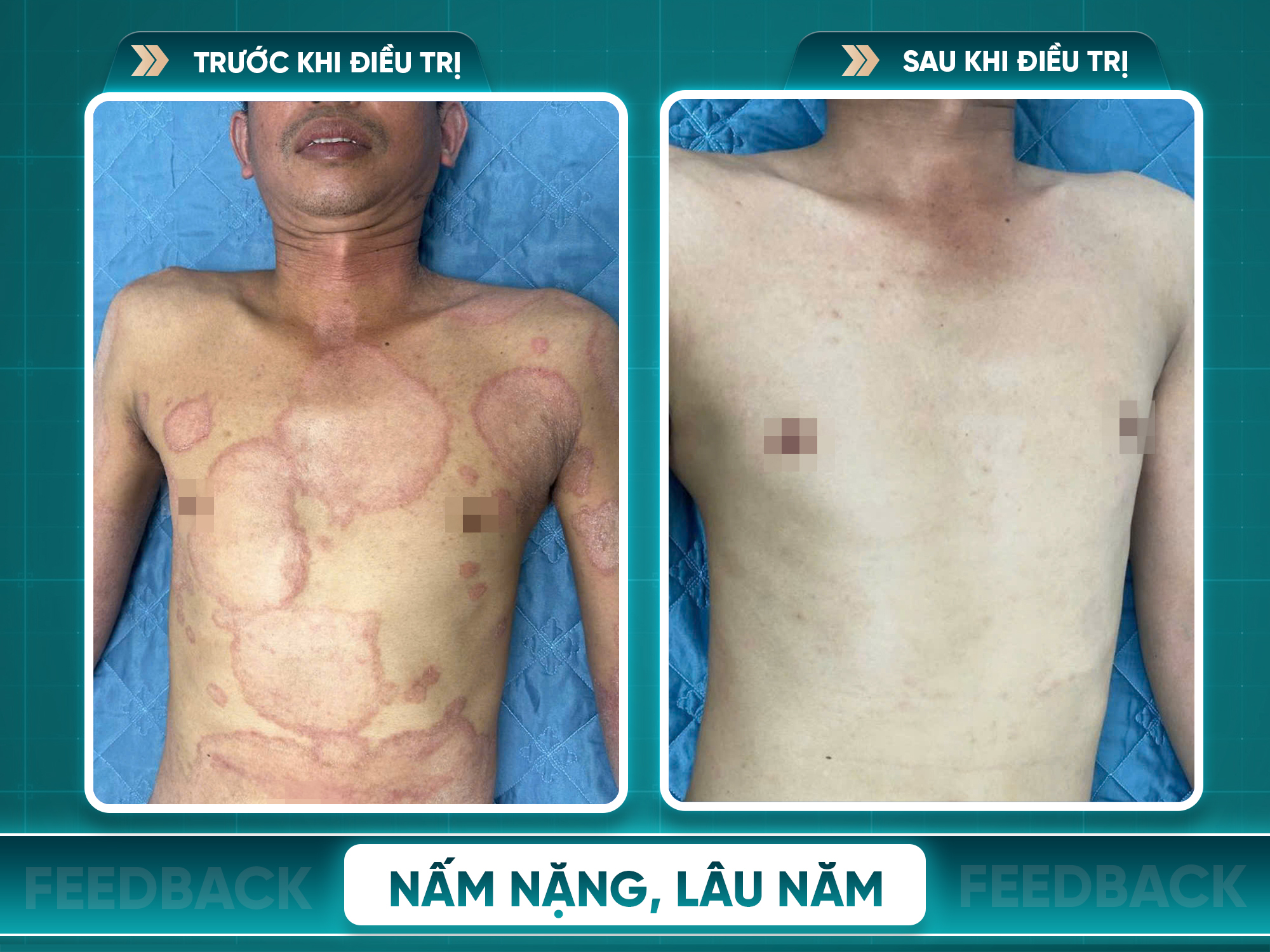 Kết quả trước và sau điều trị nấm da