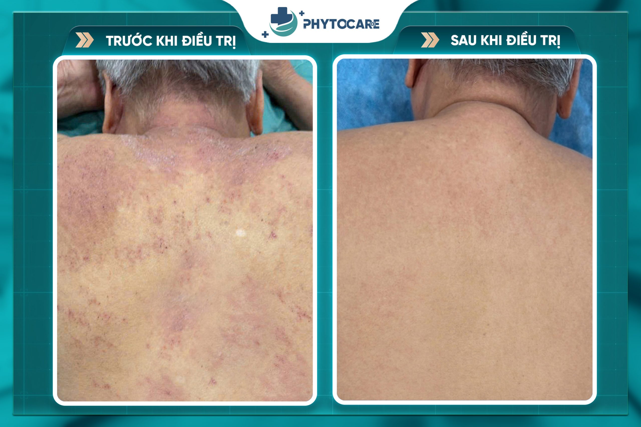 Hình ảnh trước và sau khi điều trị 1