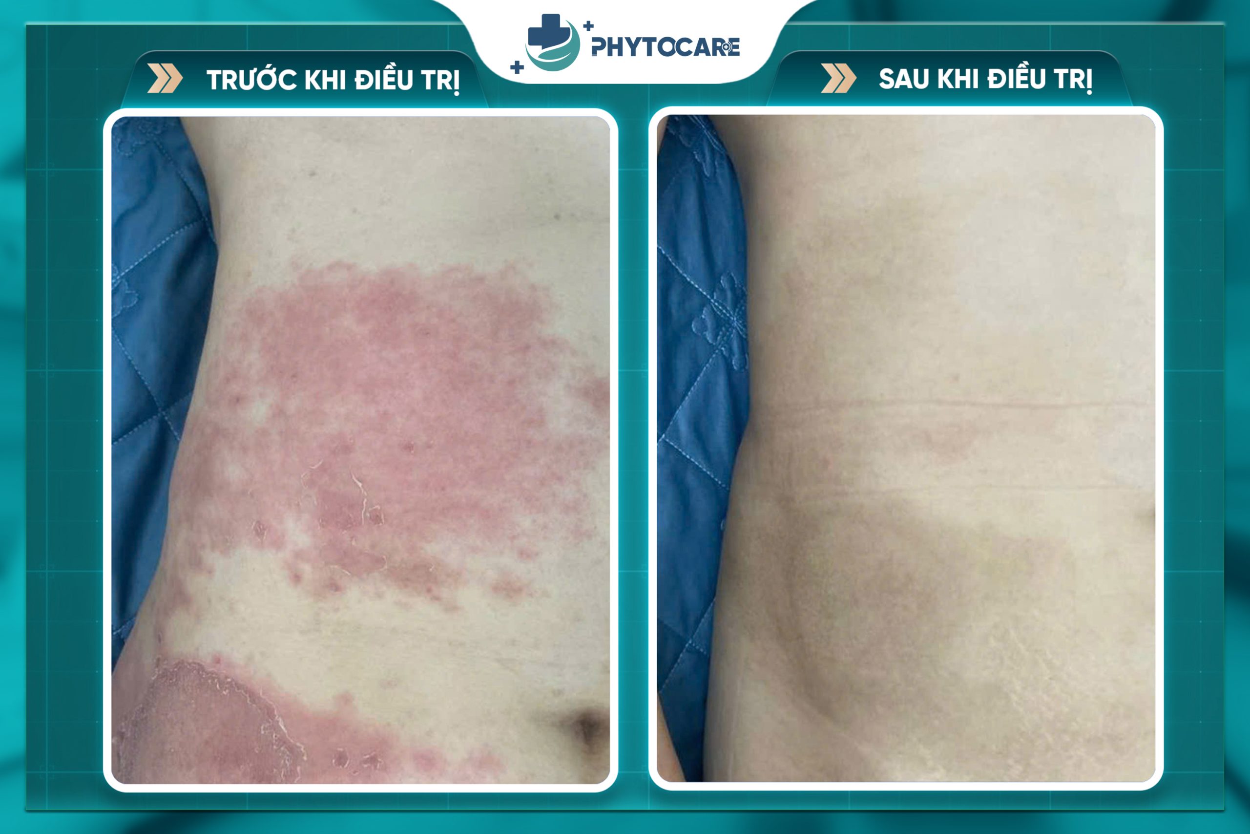 Hình ảnh trước và sau khi điều trị 2