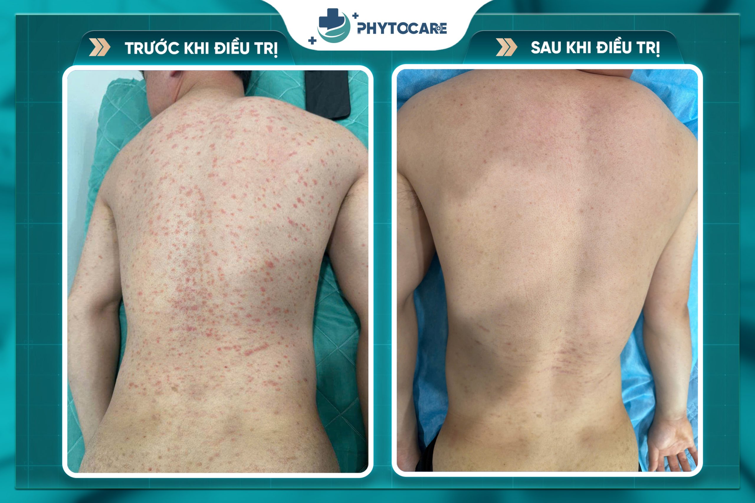 Hình ảnh trước và sau khi điều trị 3