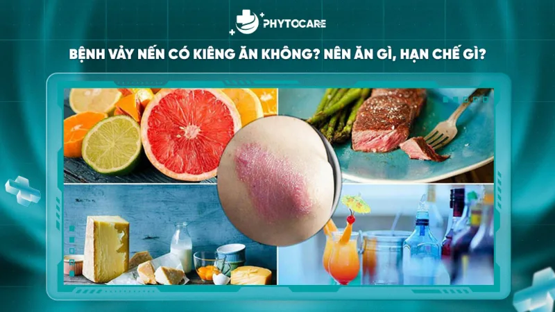 Bệnh vảy nến có kiêng ăn không – nên ăn gì, hạn chế gì