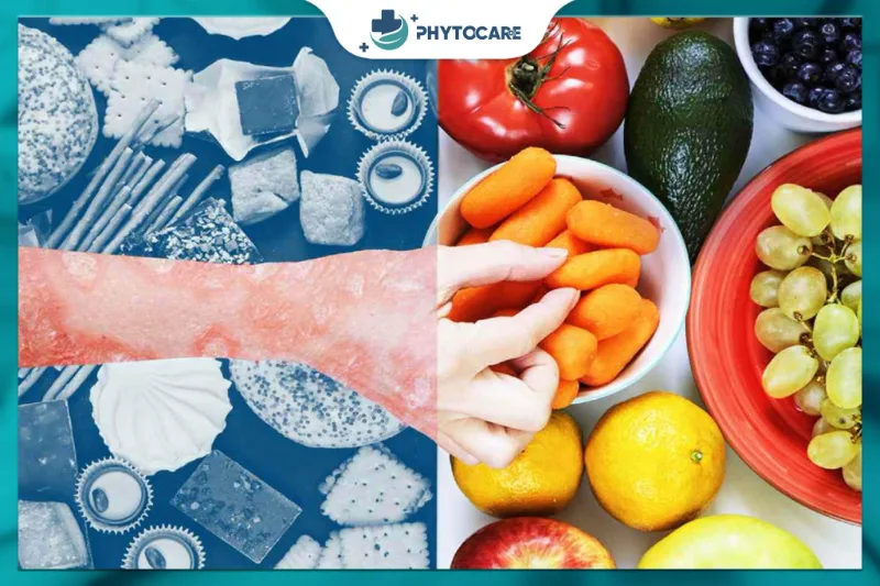 Người bị vảy nến nên hạn chế thực phẩm chế biến sẵn và nhiều đường