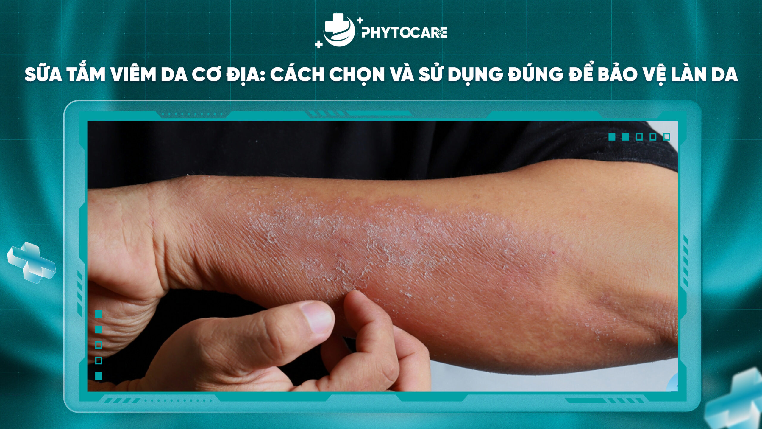 Sữa tắm viêm da cơ địa: Cách chọn và sử dụng đúng để bảo vệ làn da