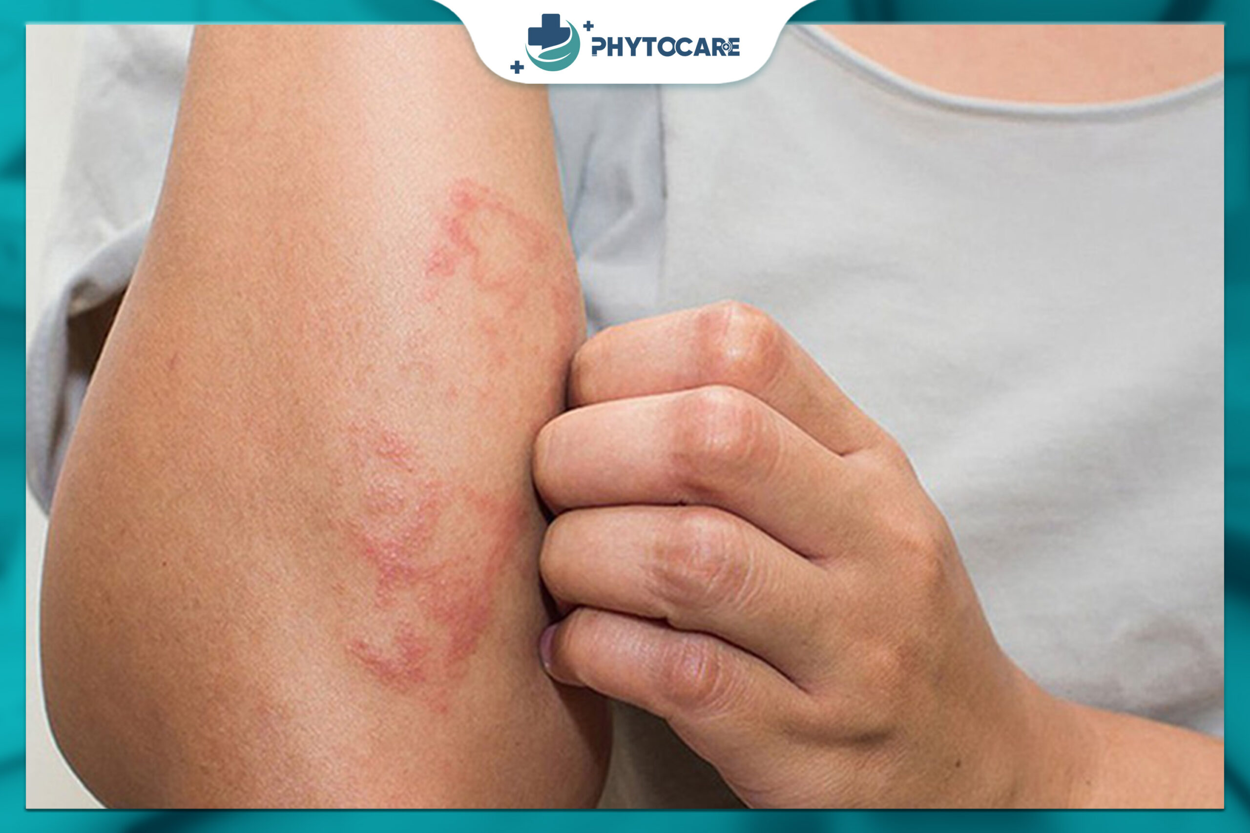 Da bị đỏ, ngứa cần được chăm sóc đúng cách